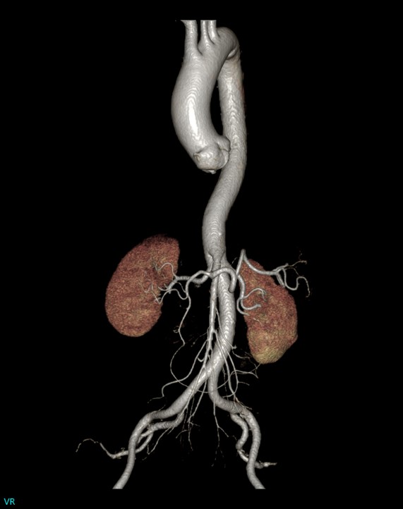 imagen angiografia aorta